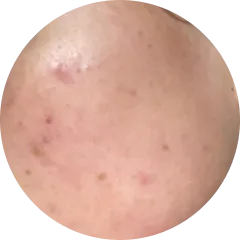 Weak Skin Barrier