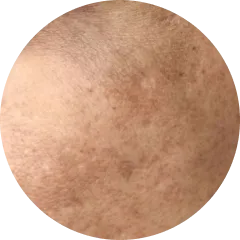 Acne & Breakouts