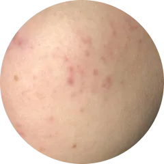 Post-Acne Marks & Pigmentation
